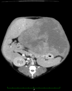 肝臓腫瘍　CT