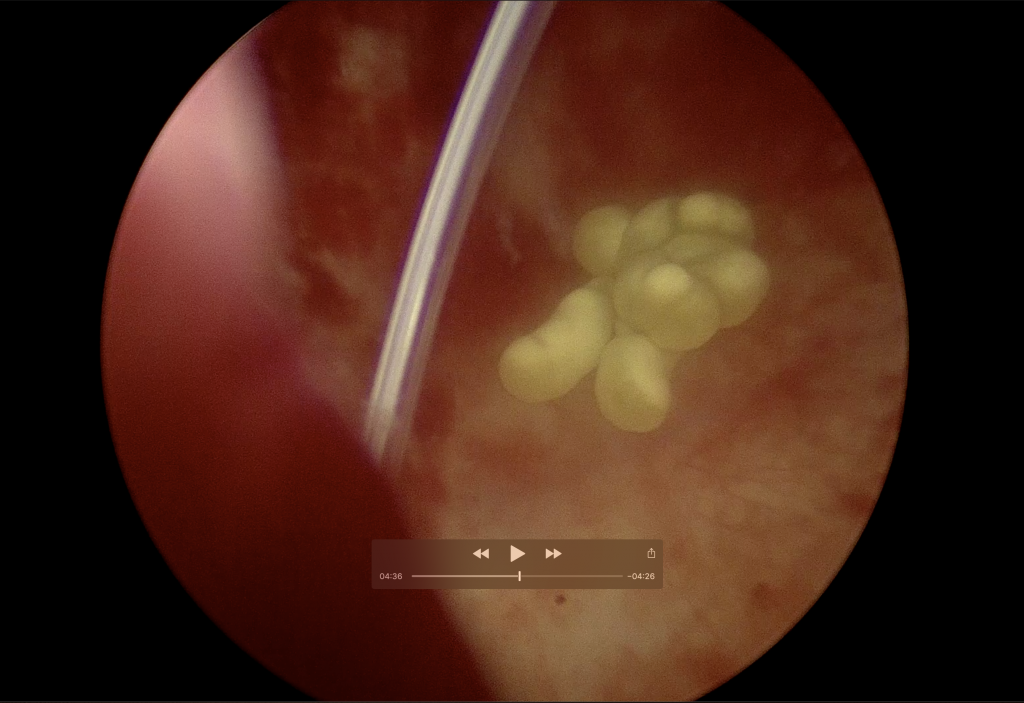 膀胱結石、腹腔鏡