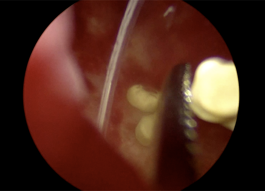 膀胱結石、腹腔鏡、鉗子で摘出