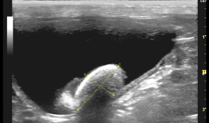 膀胱結石　超音波画像