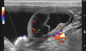 膀胱腫瘍　超音波画像